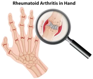 hcqs 200mg used for Rheumatic arthritis 